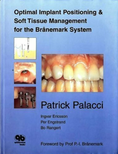 Optional Implant Positioning & Soft Tissue Management for the Branemark System