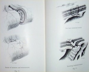 Sutures and Techniques for Wound Closure