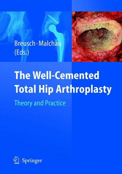 The Well-Cemented Total Hip Arthroplasty: Theory and Practice
