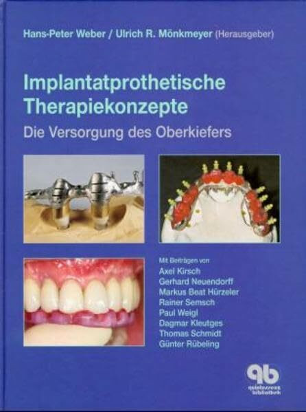 Implantatprothetische Therapiekonzepte: Die Versorgung des Oberkiefers