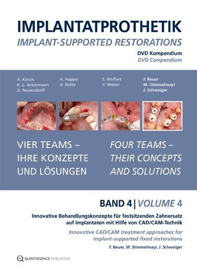 DVD-Kompendium Implantatprothetik 4