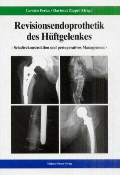 Revisionsendoprothetik des Hüftgelenks: Schaftrekonstruktion und perioperatives Management