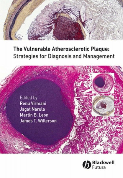The Vulnerable Atherosclerotic Plaque: Strategies for Diagnosis And Management