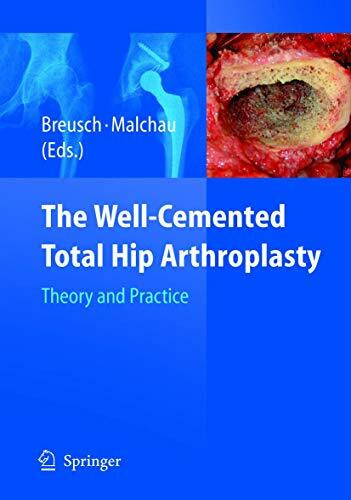 The Well-Cemented Total Hip Arthroplasty: Theory and Practice