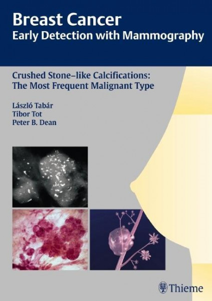 Crushed Stone-like Calcifications: The Most Frequent Malignant Type