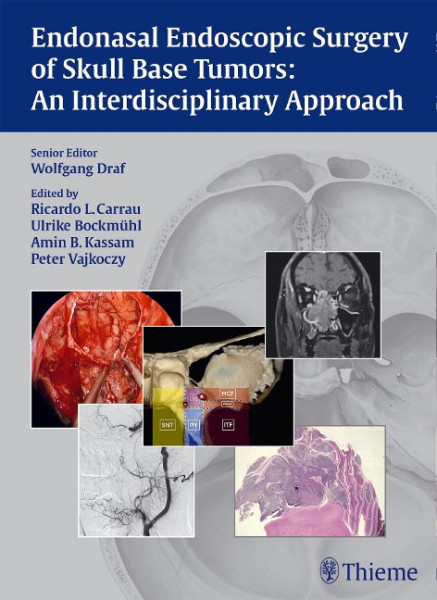 Endonasal Endoscopic Surgery of Skull Base Tumors: An Interdisciplinary Approach