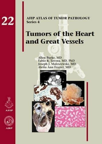 Tumors of the Heart and Great Vessels (Atlas of Tumor Pathology)