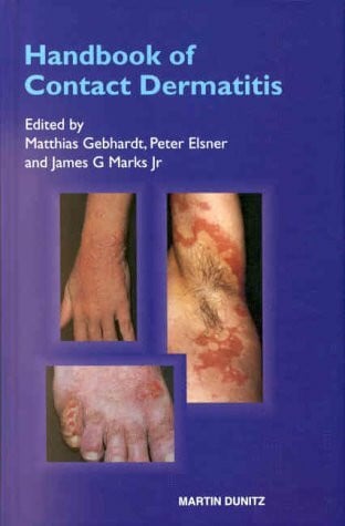 Handbook of Contact Dermatitis
