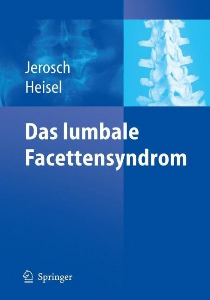 Das lumbale Facettensyndrom