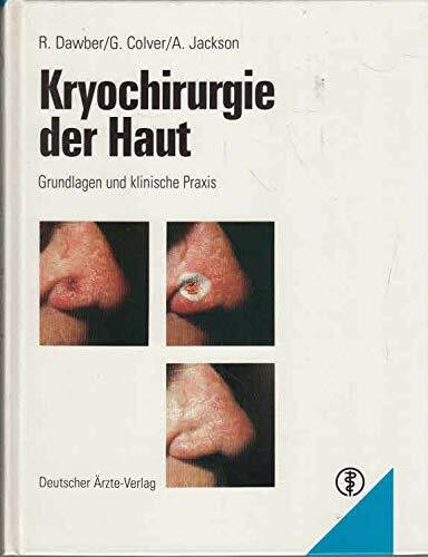 Kryochirurgie der Haut: Grundlagen und klinische Praxis