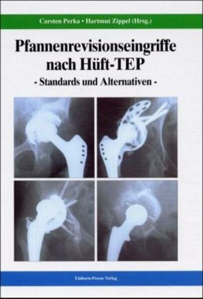 Pfannenrevisionseingriffe nach Hüft-TEP: Standards und Alternativen