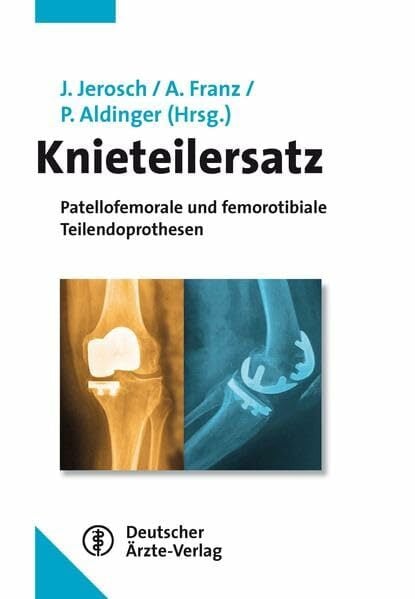 Knieteilersatz: Patellofemorale und femorotibiale Teilendoprothesen Knieteilersatz: Patellofemorale und femorotibiale Teilendoprothesen