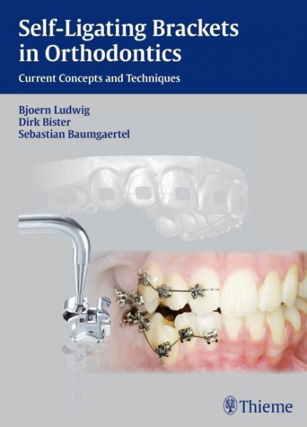 Self-ligating Brackets in Orthodontics