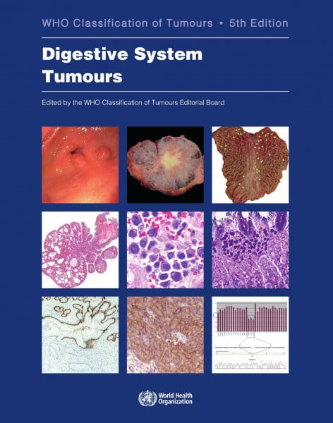 Digestive System Tumours: Who Classification of Tumours (World Health Organization Classification of Tumours, 1, Band 1)