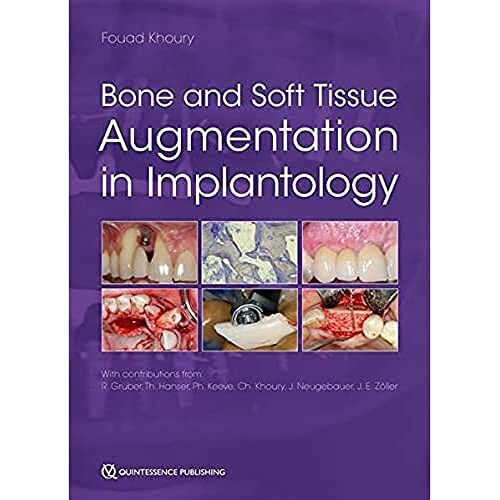 Bone and Soft Tissue Augmentation in Implantology