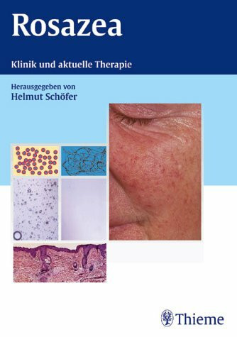 Rosazea: Klinik und aktuelle Therapie