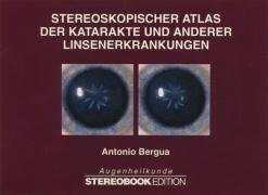 Stereoskopischer Atlas der Katarakte und anderer Linsenerkrankungen