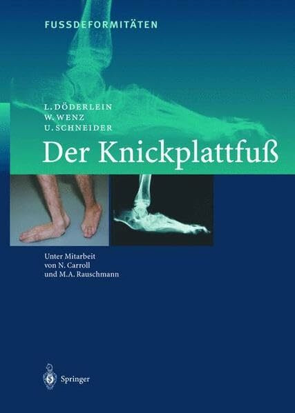 Fussdeformitäten: Der Knickplattfuss