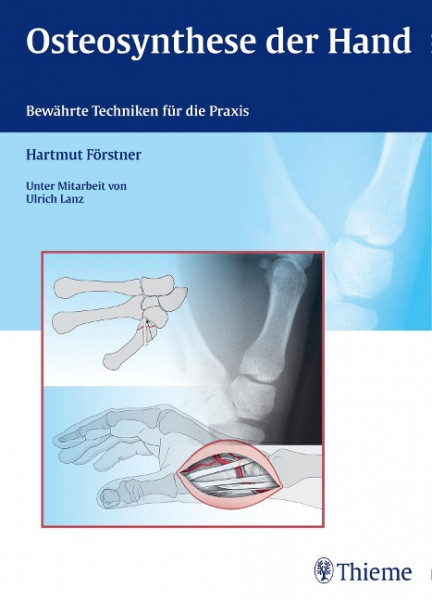 Osteosynthese der Hand