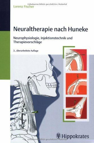 Neuraltherapie nach Huneke