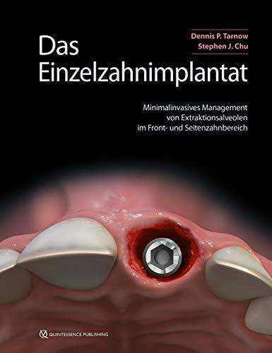 Das Einzelzahnimplantat: Minimalinvasives Management von Extraktionsalveolen im Front- und Seitenzahnbereich