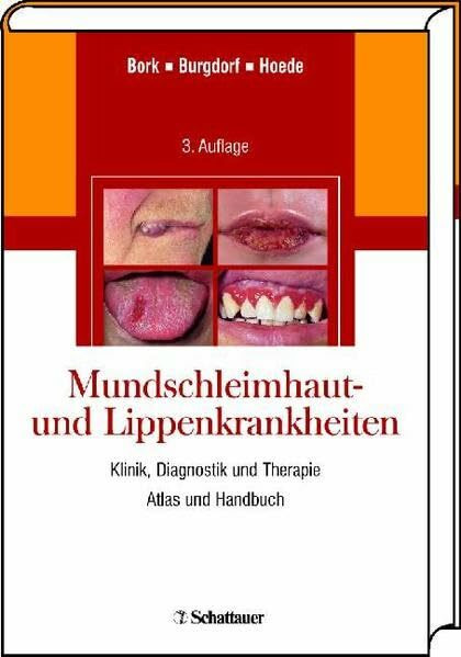 Mundschleimhaut- und Lippenkrankheiten: Klinik, Diagnostik und Therapie Atlas und Handbuch
