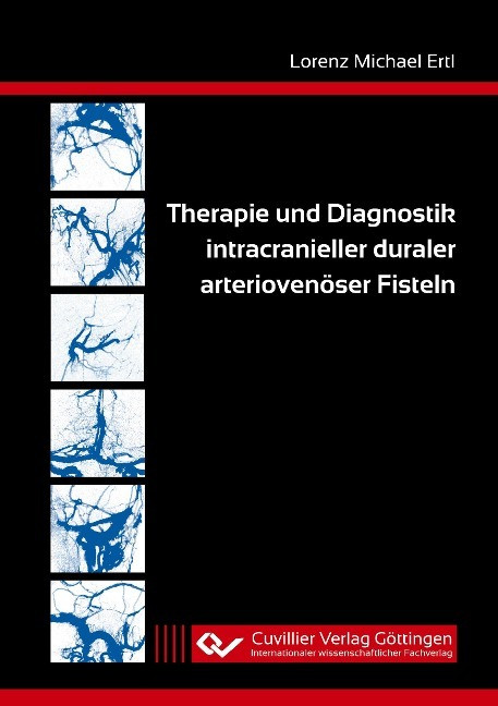 Therapie und Diagnostik intracranieller duraler arteriovenöser Fisteln