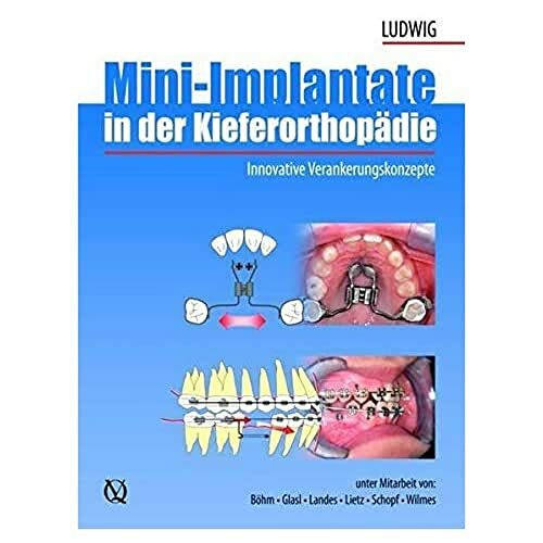 Mini-Implantate in der Kieferorthopädie