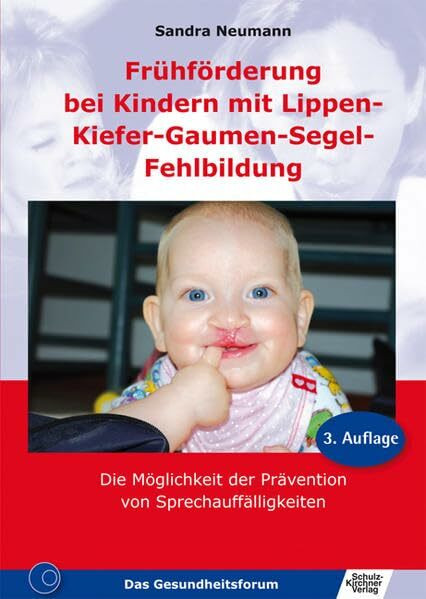 Frühförderung bei Kindern mit Lippen-Kiefer-Gaumen-Segel-Fehlbildung: Die Möglichkeit der Prävention von Sprechauffälligkeiten
