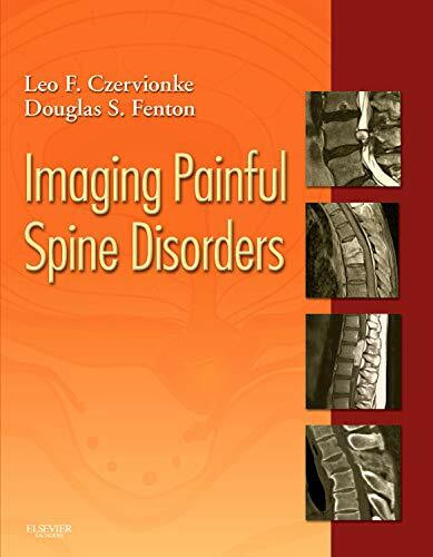 Imaging Painful Spine Disorders: Expert Consult