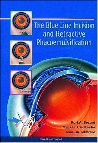 The Blue Line Incision and Refractive Phacoemulsification The Blue Line Incision and Refractive Phacoemulsification