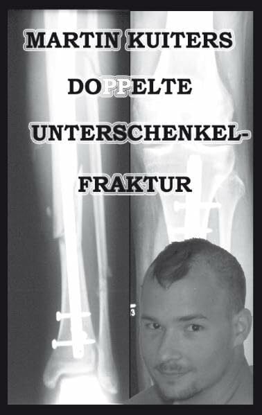 Doppelte Unterschenkelfraktur