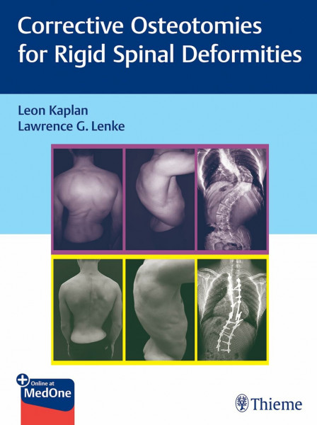 Corrective Osteotomies for Rigid Spinal Deformities: Besteht aus: 1 Buch, 1 E-Book