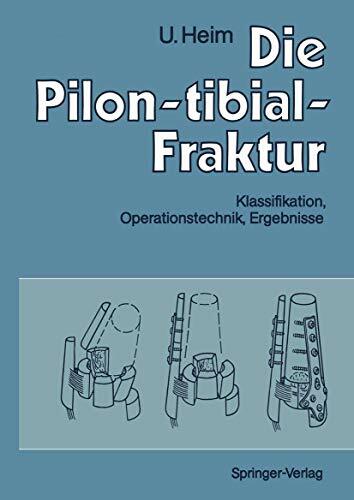 Die Pilon-tibial-Fraktur: Klassifikation, Operationstechnik, Ergebnisse Die Pilon-tibial-Fraktur: Klassifikation, Operationstechnik, Ergebnisse