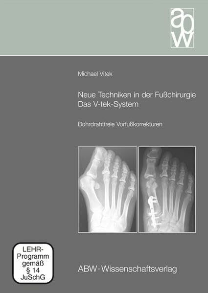 Neue Techniken in der Fußchirurgie - Das V-tek-System: Bohrdrahtfreie Vorfußkorrekturen (mit Begleit-DVD)