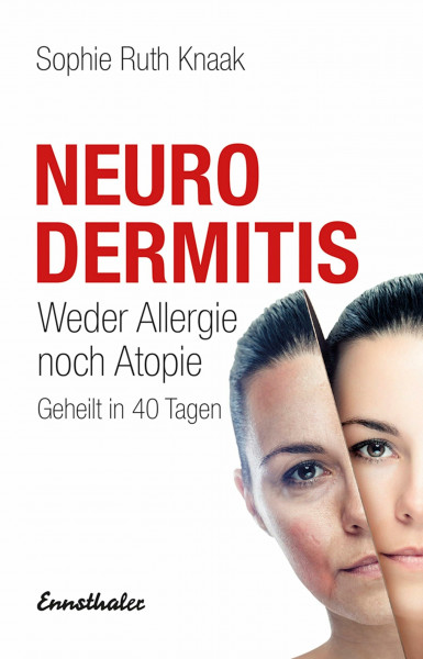 Neurodermitis: Weder Allergie noch Atopie - Geheilt in 40 Tagen