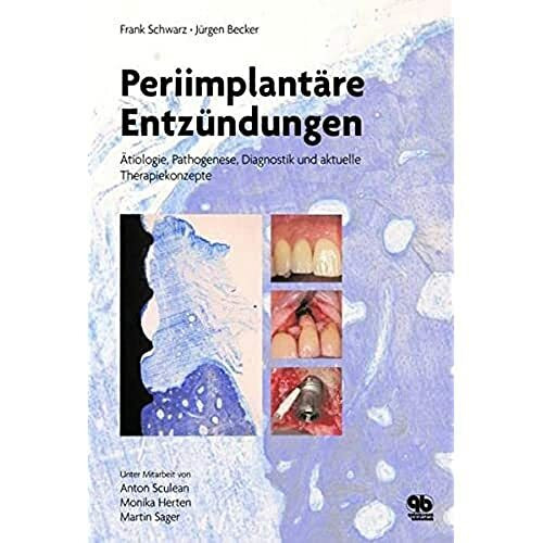 Periimplantäre Entzündungen: Ätiologie, Pathogenese, Diagnostik und aktuelle Therapiekonzepte