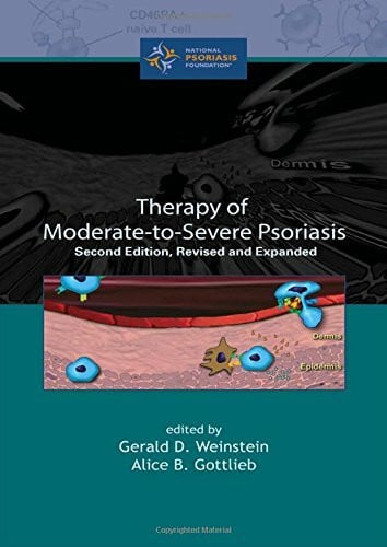 Therapy of Moderate-To-Severe Psoriasis