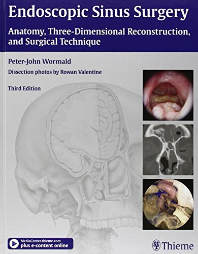 Endoscopic Sinus Surgery: Anatomy, Three-Dimensional Reconstruction, and Surgical Technique: Anatomy, Three-Dimensional Reconstruction, and Surgical... Endoscopic Sinus Surgery: Anatomy, Three-Dimensional Reconstruction, and Surgical Technique: Anatomy, Three-Dimensional Reconstruction, and Surgical Technique. Plus e-content online