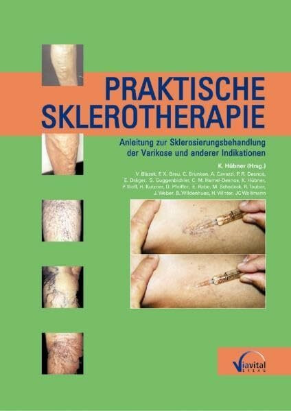 Praktische Sklerotherapie: Sklerosierungstherapie der Varikose und anderer Indikationen