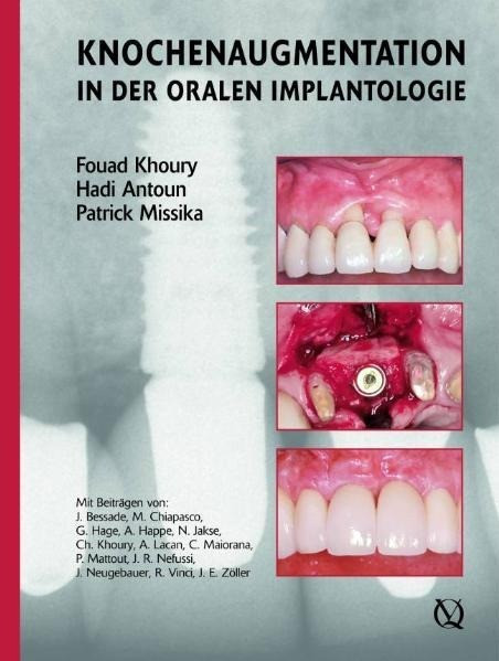 Augmentive Verfahren in der oralen Implantogie