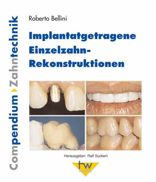 Implantatgetragene Einzelzahn-Rekonstruktionen