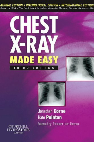 Chest X-Ray Made Easy Third Edition